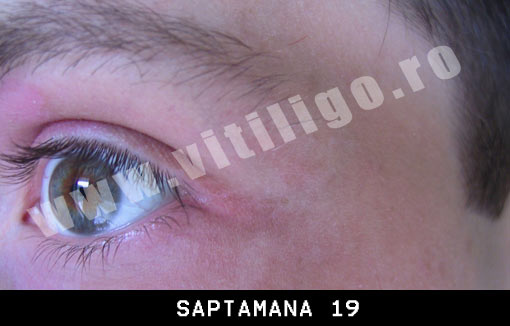 depigmentarea pielii in jurul ochilor)