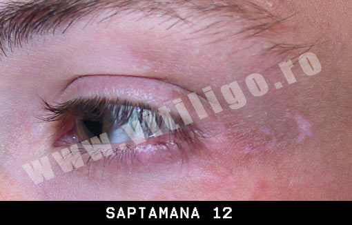 depigmentarea pielii in jurul ochilor echipamentele supraviețuiesc anti-îmbătrânire elvețiană
